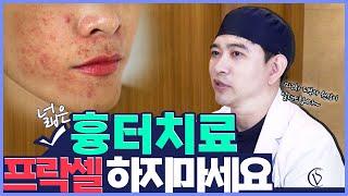 여드름흉터 치료해도 소용없는 이유! 헛돈쓰신분들 꼭 보세요!