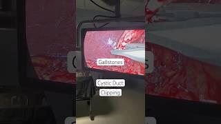 Cystic Duct Clipping I Gallstones operation I SURGERY KAISE HOTA HAI I Cholecystectomy