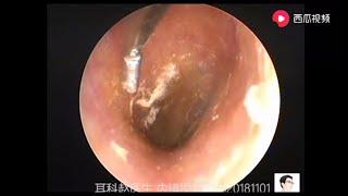 Treatment of fungus in external auditory canal, 11 minutes外耳道干片状真菌的处理