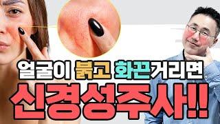 안면홍조, 화끈거림이 심하다면 신경성 주사를 의심해봐야 합니다. 안면홍조 중 가장 심각한 질환