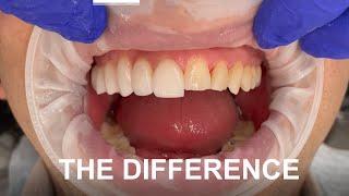 See it to believe it! Completely non-cutting veneers by Dr Aleem. Zero Damage to Natural teeth!