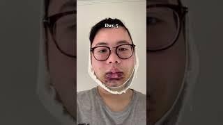 Jaw Surgery Transformation #2