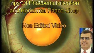 Tips of Phacoemulsification and Horizontal Phaco Chop , Non Edited Video.