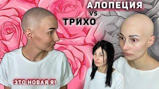 Тотальная алопеция у женщины скрыта трихопигментацией. Total alopecia vs Scalp Micropigmentation.