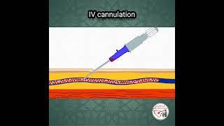  INTRAVENOUS (IV) CANNULATION ANIMATION