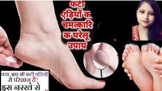 फटी एड़ियों को हमेशा के लिए ठीक करें(Home Remedies for Cracked Heel)