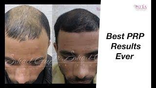 PRP Results | PRP hairloss treatment results | PRP | PRP Hairloss Before & After | PRP results Satya