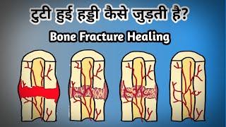 टुटी हुई हड्डी कैसे जुड़ती है? stages of fracture healing /bone fracture healing #fracturehealing.