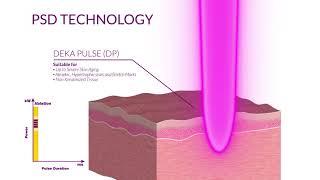 DEKA Lasers - SMARTXIDE PUNTO CO2 laser med COOLPEEL