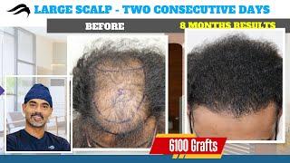 Hair Transplant In Bangalore | Best Results Cost & Clinic Of Hair Transplant In Bangalore