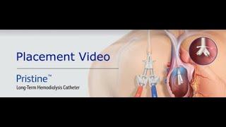 BD Pristine™ Long-Term Hemodialysis Catheter Procedural Animation (no audio)