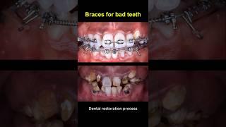 Restore bad teeth and braces #braces #orthodontist #dentist #teeth