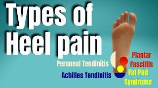 Types of Heel Pain | San Diego Sports Chiropractic