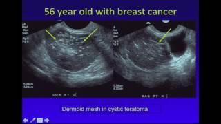 Ultrasound of Adnexal Masses