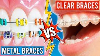 Metal Braces VS. Clear Braces!