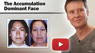 Female Facelift - The Accumulation Dominant Face - Dr. Gerald O'Daniel - Louisville Plastic Surgery