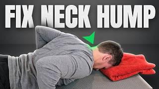 How To Get Rid Of A Neck Hump For Good! (Doctor-Approved)
