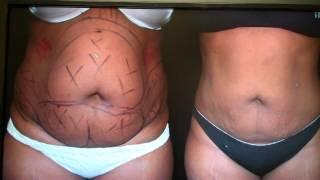 Smartlipo of Abdomen