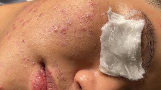 Blackheads & Whiteheads Removal New 2024 | Acne Treatment With  Bo Nguyễn Spa 033