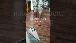 Bimaleolar fracture | Post operative follow up 4 months | Adamya Hospital videos