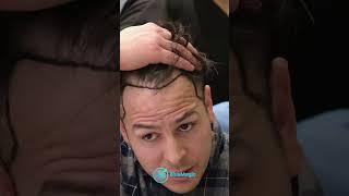 Hair Transplant Surgery