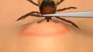 How To Remove A Tick