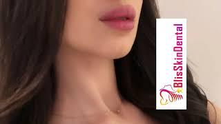 Lip Filler Treatment Result at Bliss Skin Dental Bandra