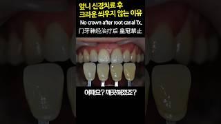 앞니 신경치료 후 보철 씌우지 않는 이유. 크라운하지 말고, 실활치미백 하면 됨. DentiTube20230913
