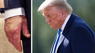Trump health goes VIRAL over swollen, bruised hands