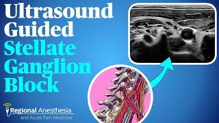 Ultrasound guided stellate ganglion block