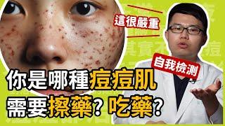 你是哪種痘痘肌？長兩顆痘痘算嚴重？應該吃藥、還是擦藥呢？皮膚科楊省三醫師教你自我檢測痘痘嚴重程度！