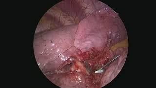 11-Minute VATS Right Lower Lobe Lobectomy (Nonedited)