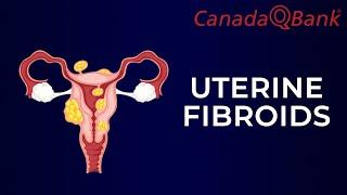 Uterine Fibroids