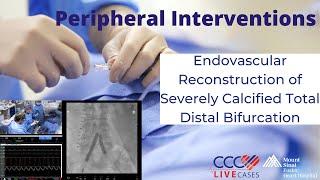 Watch Live Endovascular Reconstruction of Severely Calcified Total Distal Bifurcation