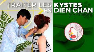 Traitement des kystes en Dien Chan