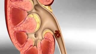 What's kidney stone, how to cure kideny stone - www.tcm-kidney.com