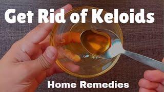 How to Get Rid of Keloids | Natural Home Remedies to Remove Keloids