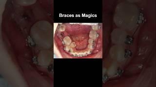 Braces as magics, fix all problem #braces #orthodontist #dentist #dentistry