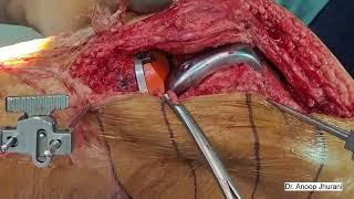 Conversion of fibrous ankylosed knee to TKR