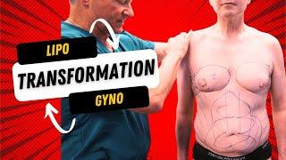  Transformative Journey: Abdominal and Flank Liposuction with Gynecomastia Surgery