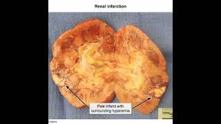 Renal Infarct #infarction #renalinfarction #renal