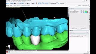 BSP 4.13: Crown for Titanium Base Abutment. AI Automatic Tooth Design. Design and Export Free!