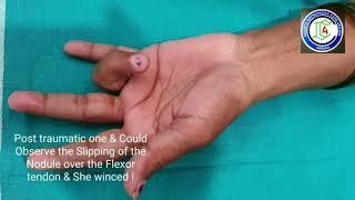 Trigger finger Examination | Ring finger Trigger | Adamya Hospital Videos