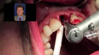 Immediate Dental Implant Surgery  - Dr Scott MacLean Front tooth