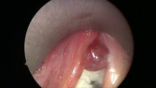 Vocal Cord Polyp Causing Hoarse Voice