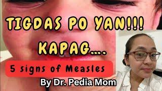 5 SIGNS may TIGDAS si baby| Symptoms of Measles in Children by Dr. Pedia Mom