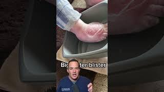 DOCTOR REACTS : POPPING HUGE BLISTER!  #shorts