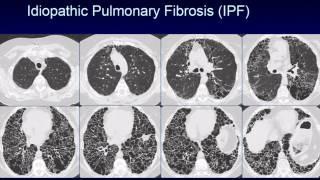 CHEST 2016 video sessions: HRCT of the chest