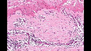 An introduction to the diagnosis of subepidermal blisters Phillip McKee