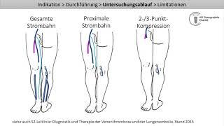 Kompressionssonographie der Beinvenen - Ausschluss einer tiefen Venenthrombose (TVT-Auschluss)